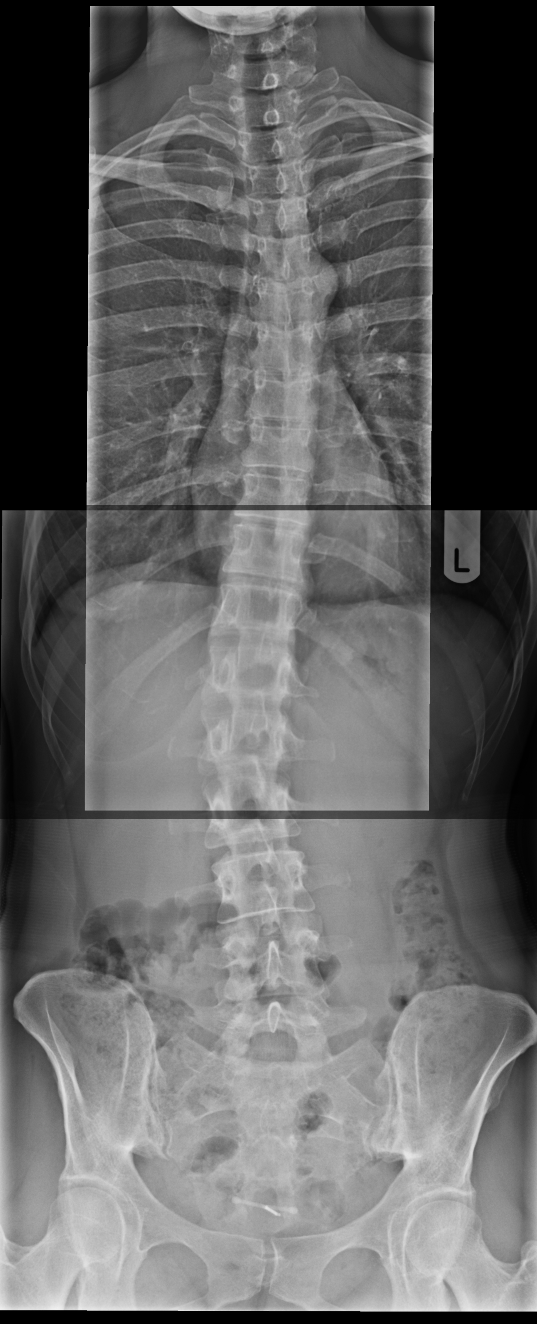 :umbar scoliosis X-ray