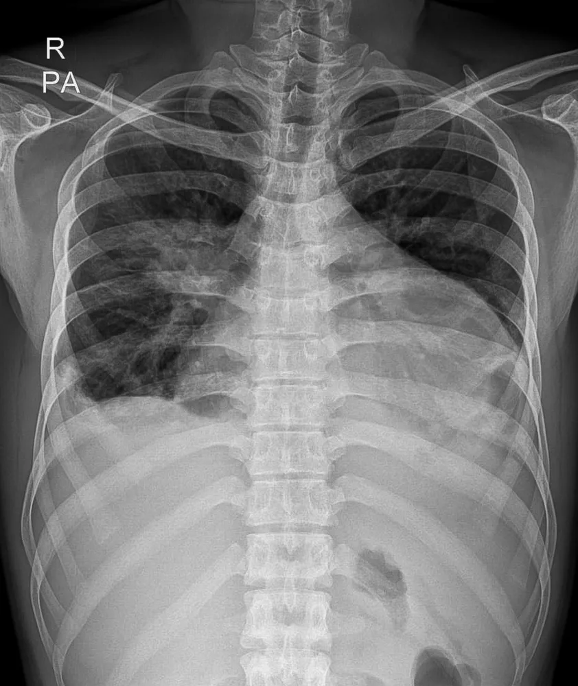 The image shows an X ray of a patient with Pericardial Effusion