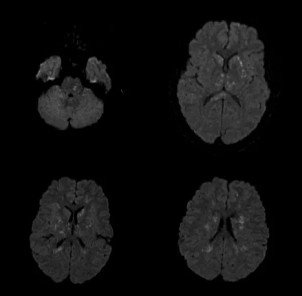 MRI Brain showing starfield pattern in FES