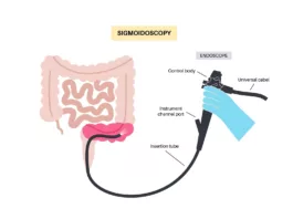 Sigmoidoscopy