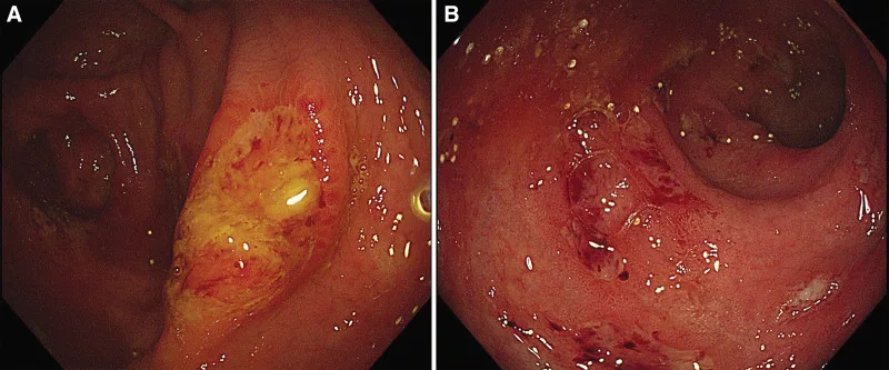 Colitis due to amoebiaisis.