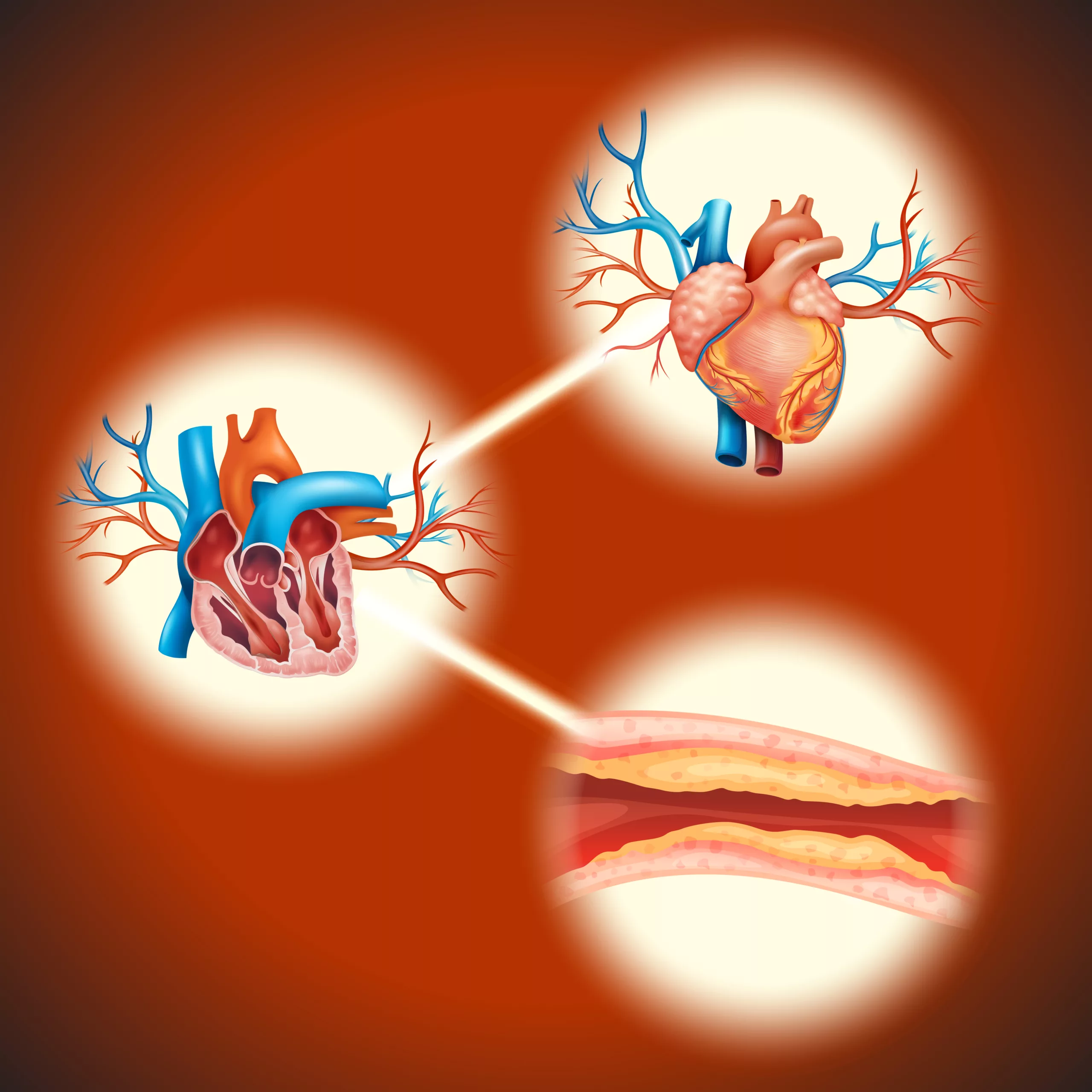 Balloon angioplasty for artherosclerotic vessels