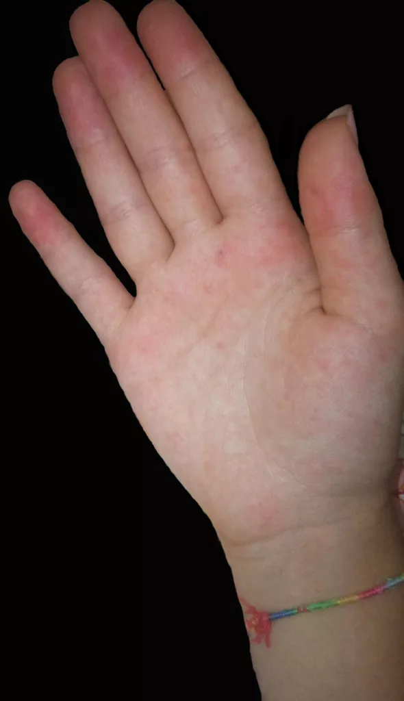 Skin Rash in Chikungunya