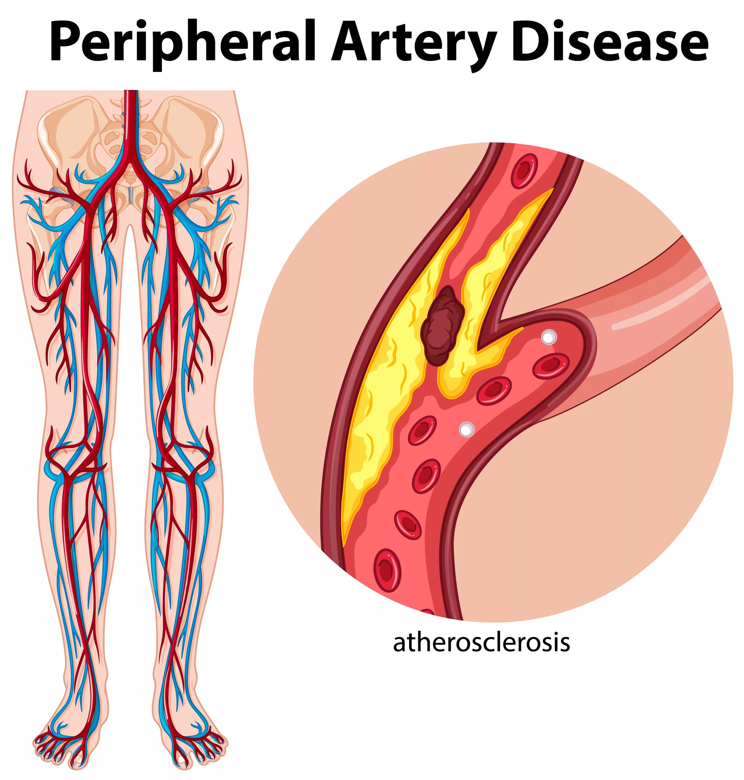 Balloon angioplasty for peripheral artery disease