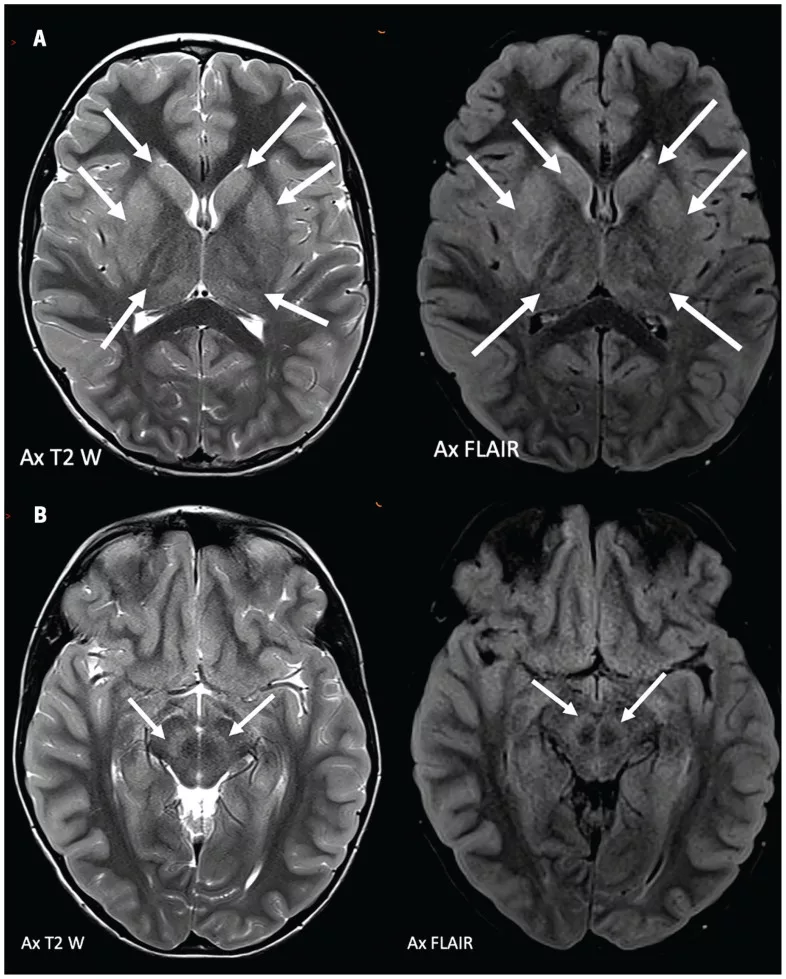 Powassan virus encephalitis