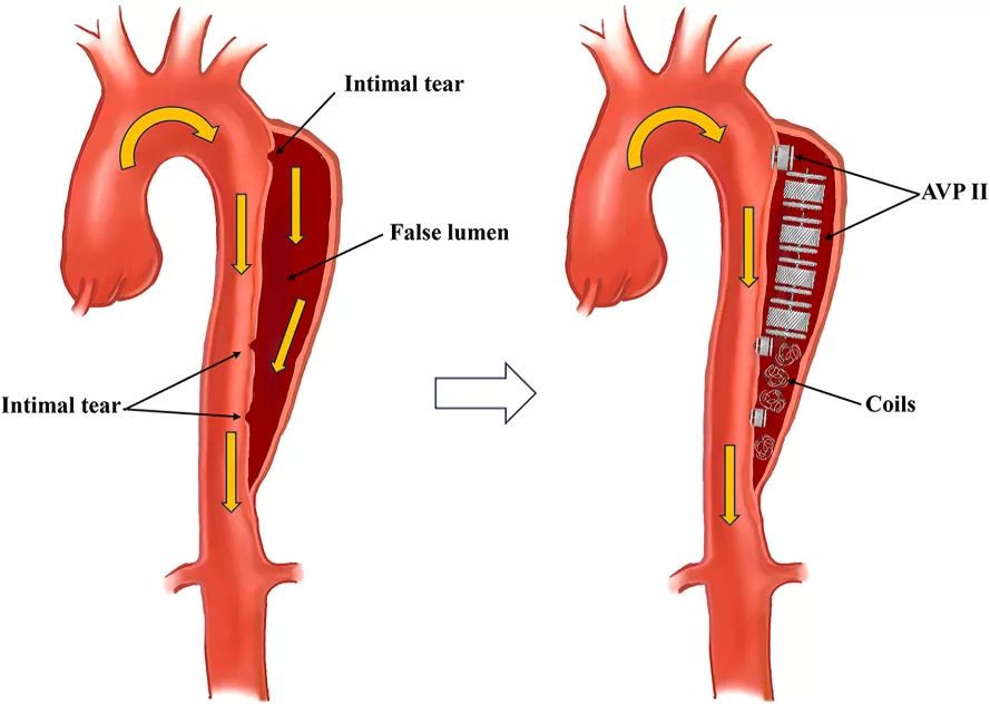 Aortic dissection treated using AVPs and coils