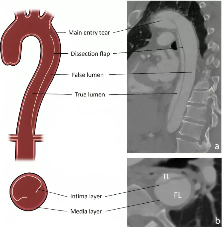 Anatomical features of type B Aortic dissections