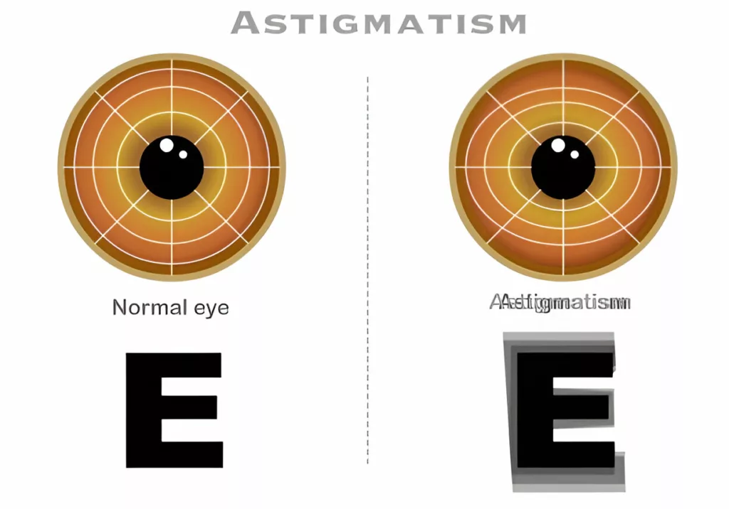 Image showing how people with keratoconus see the image 