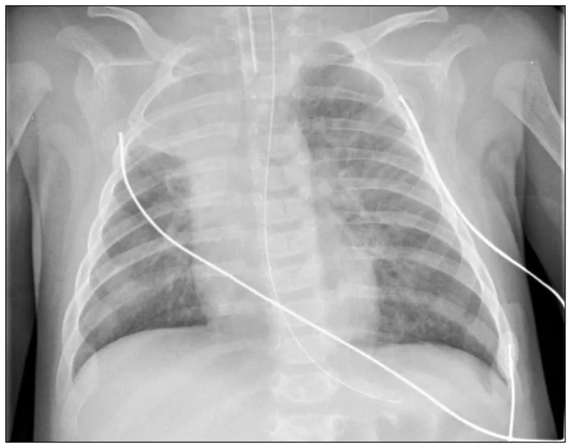 Chest radiograph of a 3-month-old infant with severe RSV bronchiolitis 