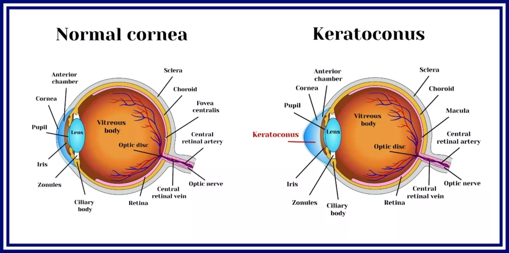 Left image showing normal shape of cornea and Right image showing bulging of cornea in keratoconus 