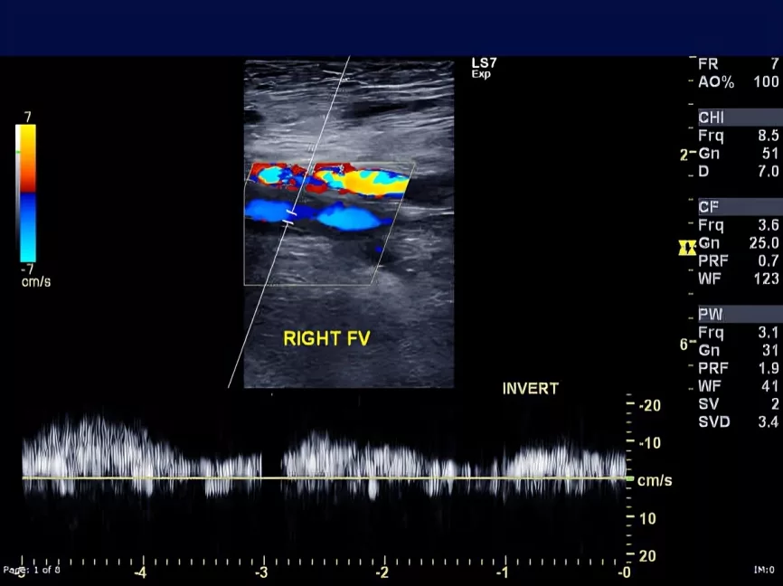 A doppler ultrasound detecting blood flow in vessels in order to diagnose air embolism