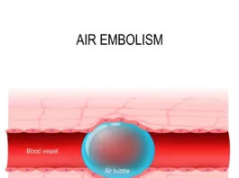 Air embolism