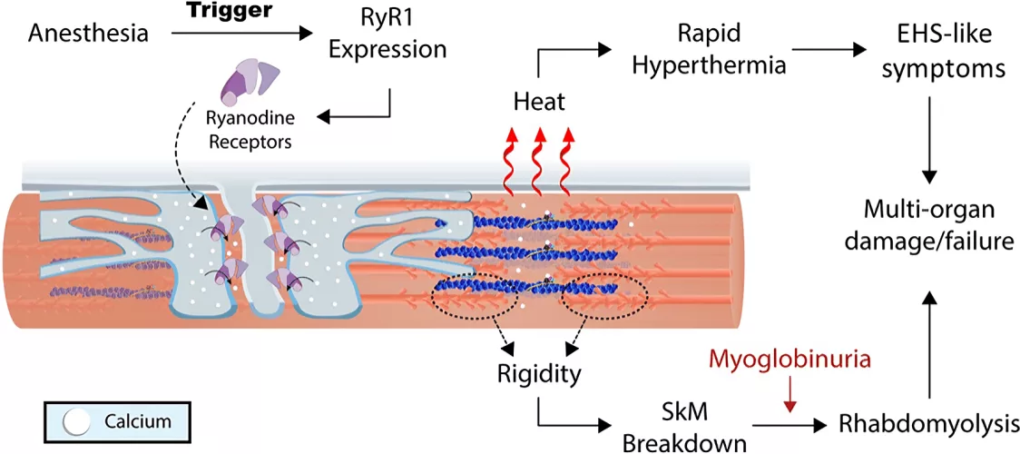 Malignant Hyperthermia