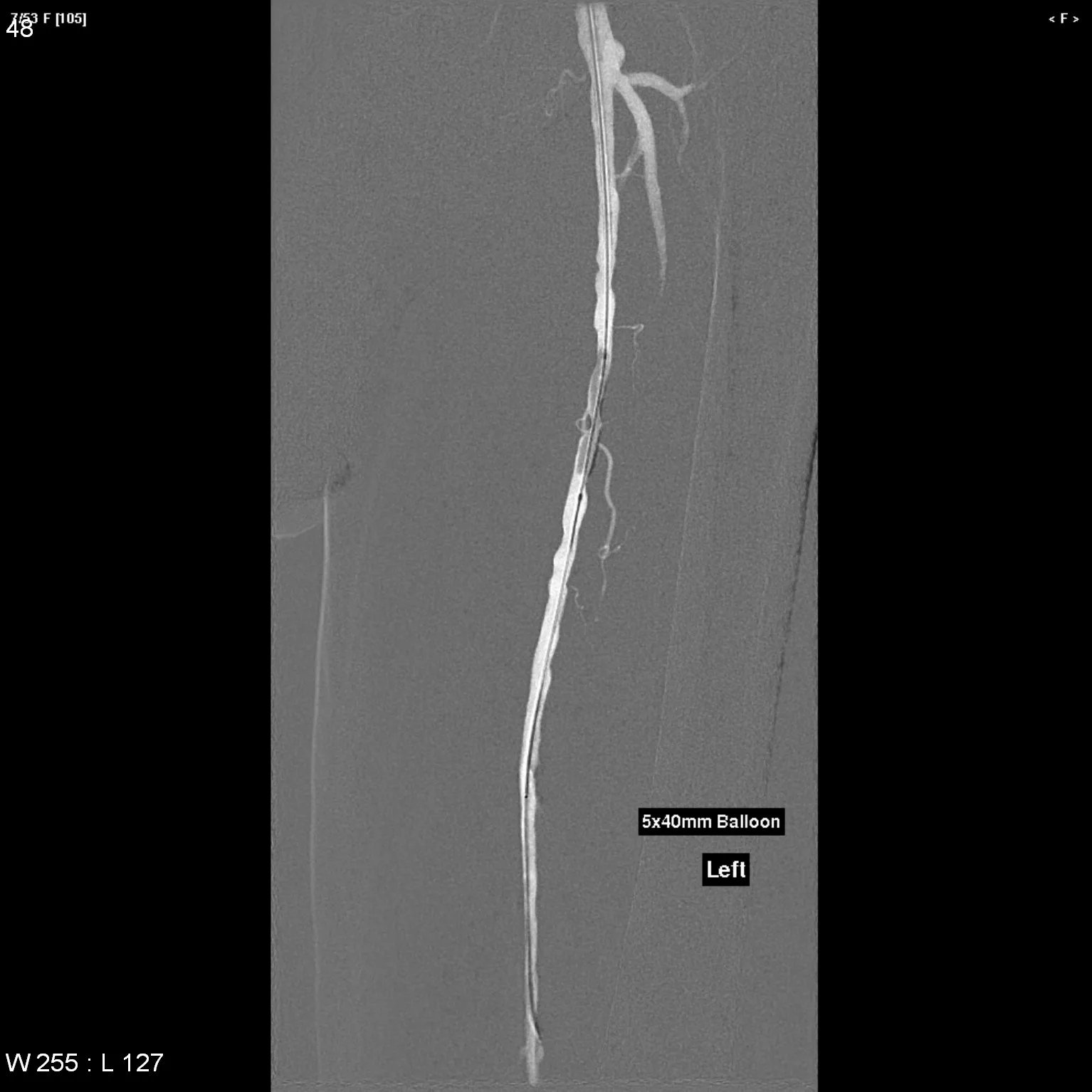 Balloon angioplasty