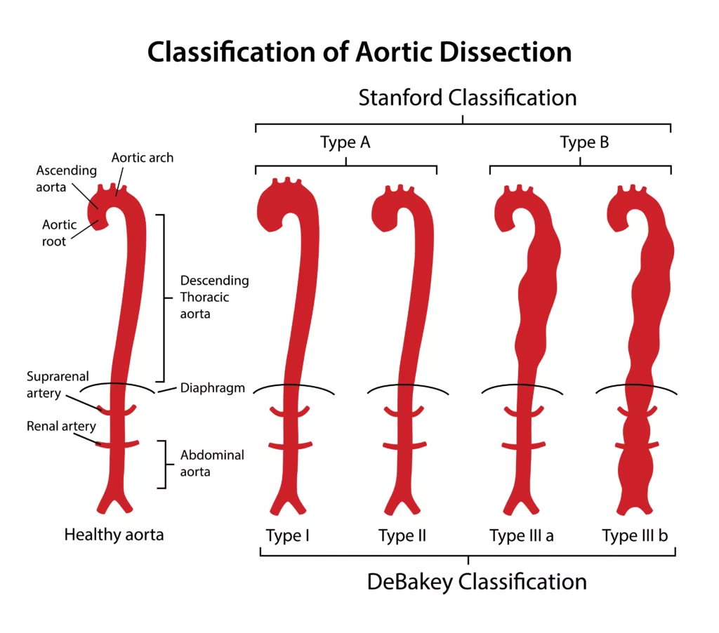 Classification of Aortic Dissection