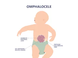 Abdominal Wall Defect - Omphalocele