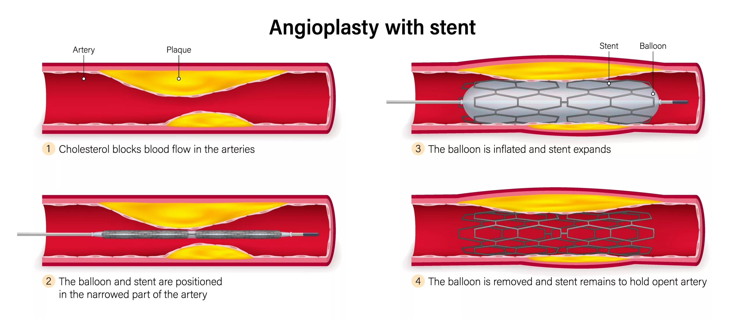 Balloon angioplasty with stent