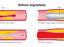 Balloon angioplasty