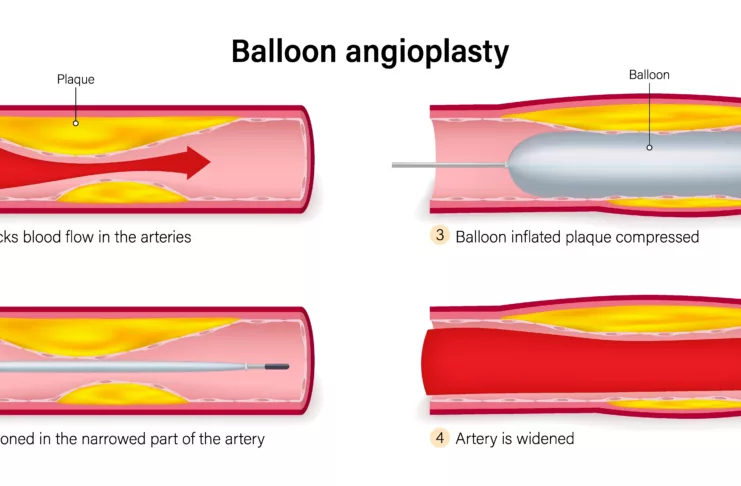 Balloon angioplasty