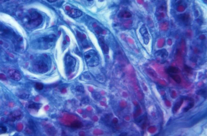 Photomicrograph revealing histopathological changes in a skin tissue specimen