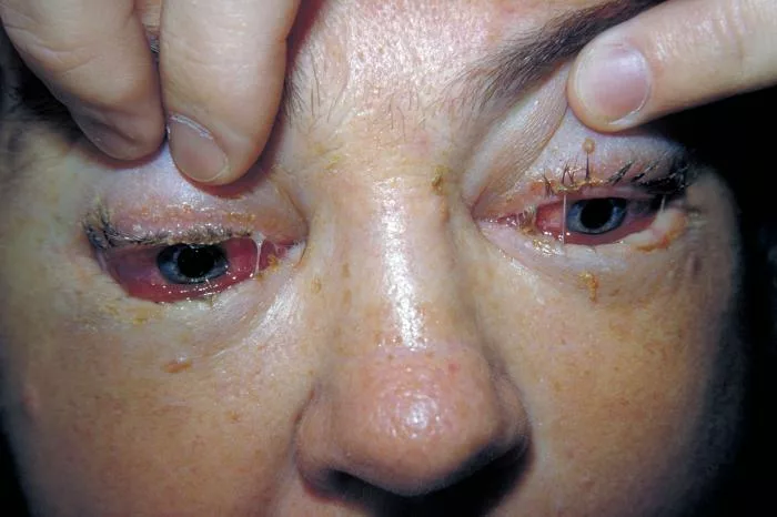 Clinical appearance of a patient’s eyes with periorbital swelling in case of trichinosis