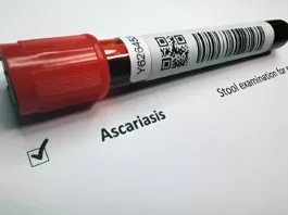 Ascariasis