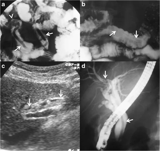 Ascariasis cases