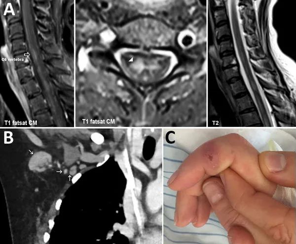 Cat scratch disease induced transverse myelitis