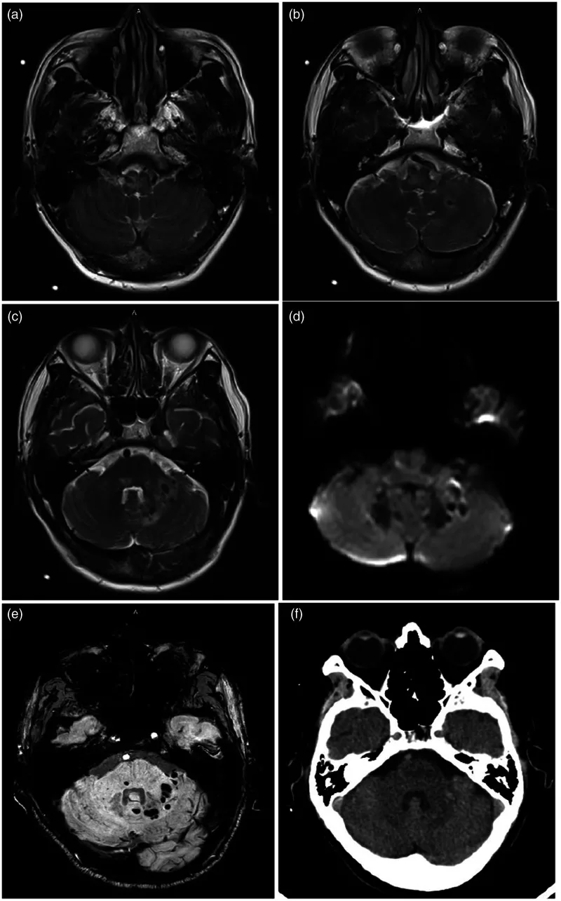 Listeriosis-induced rhomboencephalitis.