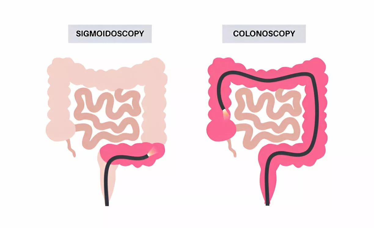 Difference between Sigmoidoscopy and Colonoscopy