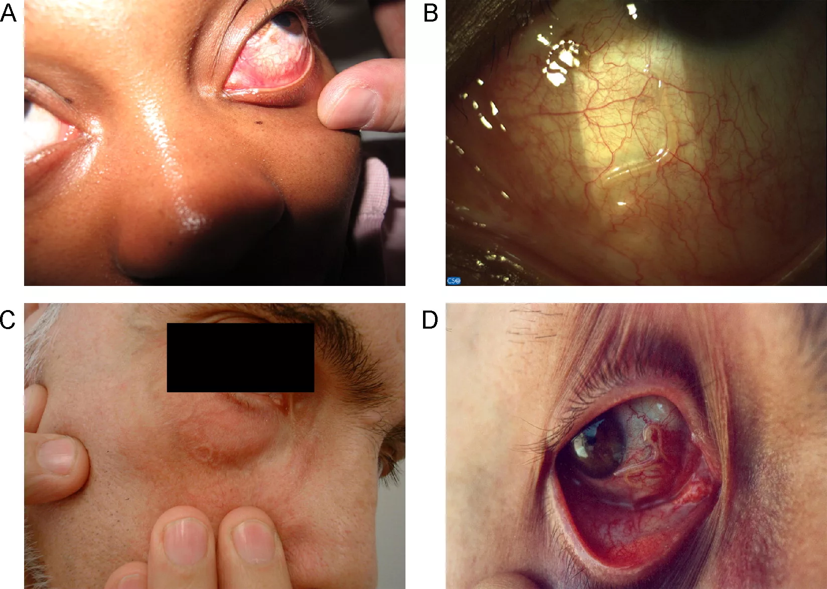 Symptoms of Clinical Manifestations of Loiasis