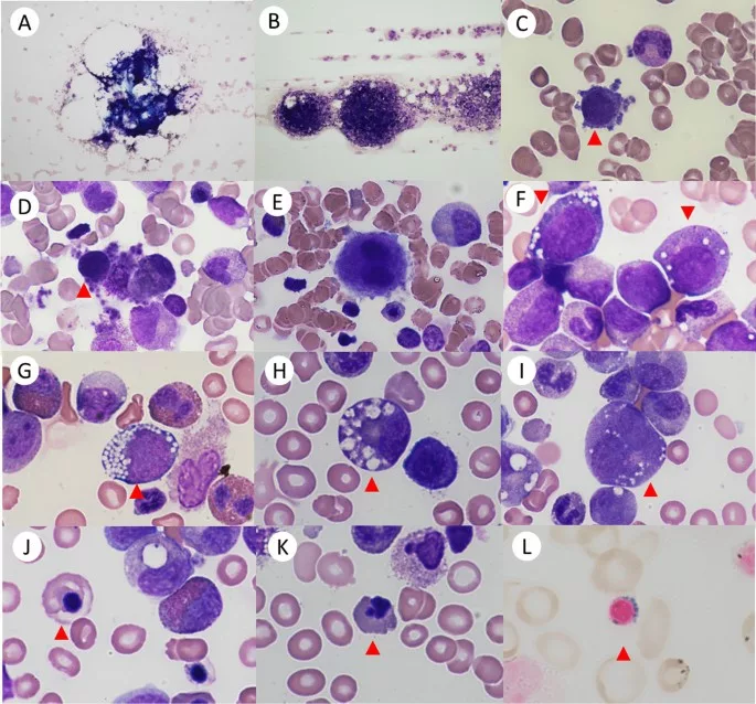 The image shows Microscopic findings in patients with Pearson Syndrome