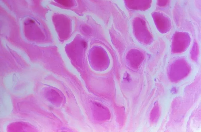 Under a magnification of 900X, histopathology of molluscum contagiosum papule. 