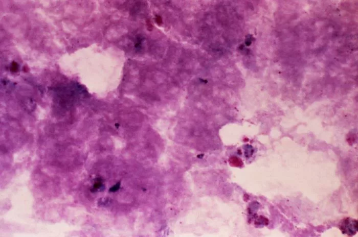 Photomicrograph of a Giemsa stained blood film specimen, which was extracted from an infected human