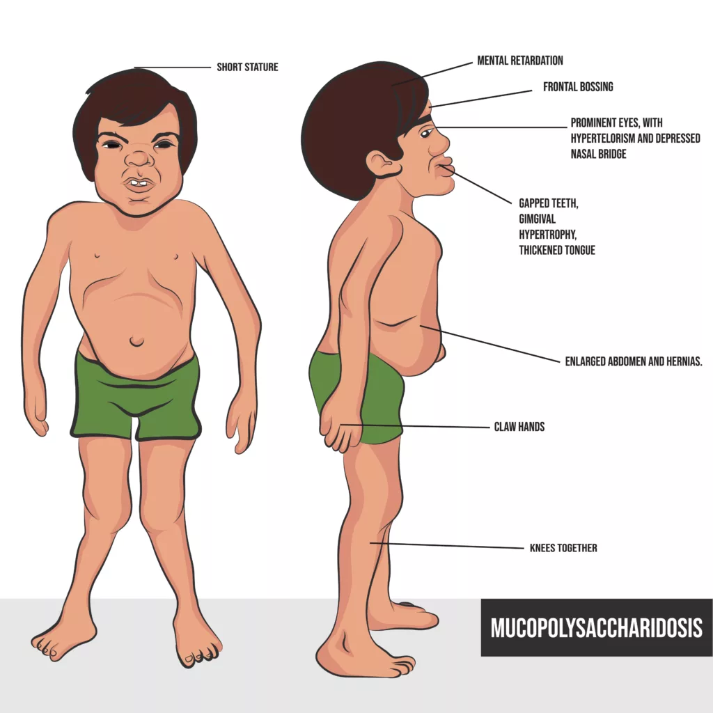 The Image shows signs and symptoms of Hunter Syndrome