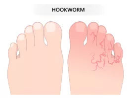 Hookworm Infection