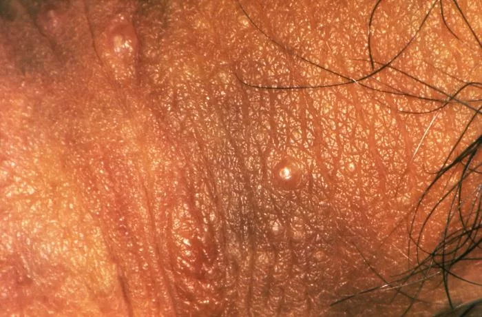 Molluscum contagiosum on penile shaft of patient 