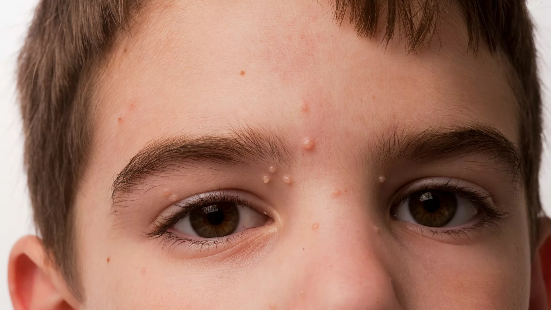 Molluscum contagiosum lesions 