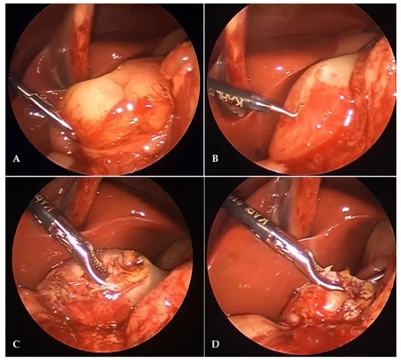 Intraoperative finding in 14-day-old male infant with hypertrophic pyloric stenosis who received laparoscopic pyloromyotomy: (A) Laparoscopic view of hypertrophied pylorus; (B) pyloromiotomy using 3-mm diathermy hook; (C) separation of the pyloric muscle layer by blunt dissection; (D) end of the procedure, mucosa clearly protrudes trough the incision.