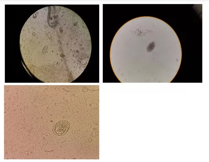 microscopical analysis of the stools showing eggs of Ancylostoma duodenale. 