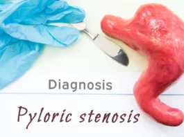 Diagnosis and management of pyloric stenosis