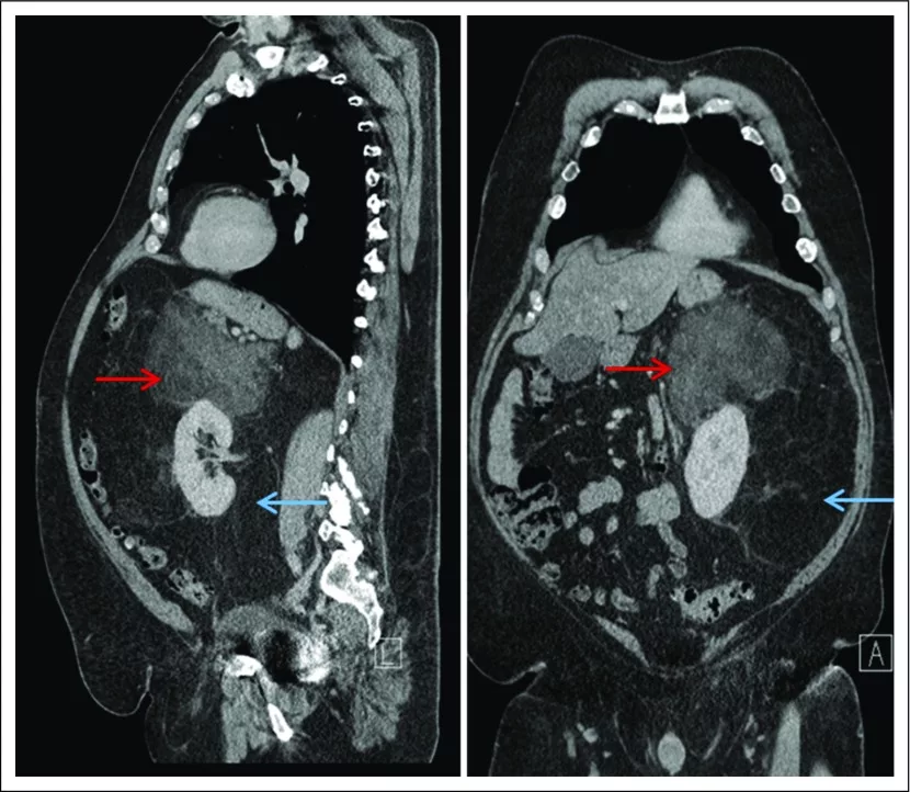 Liposarcoma CT scan