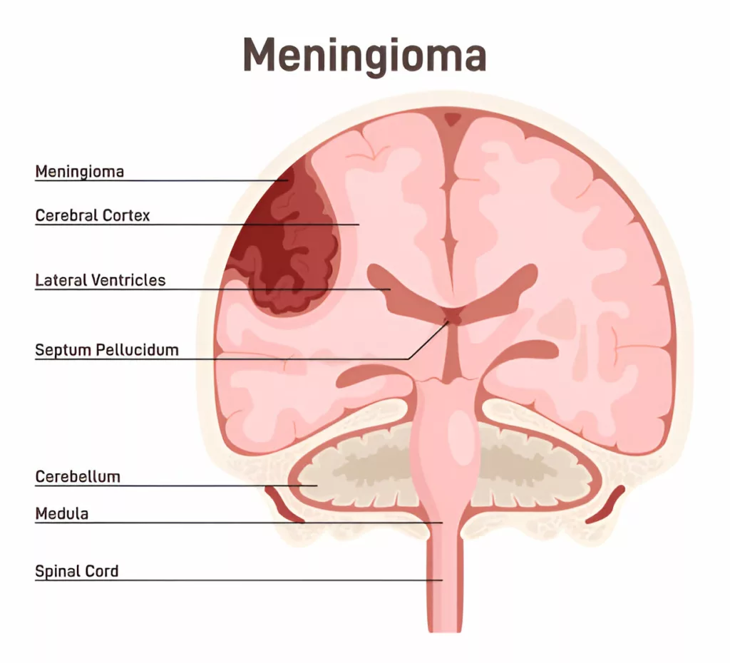  Illustration of Meningioma