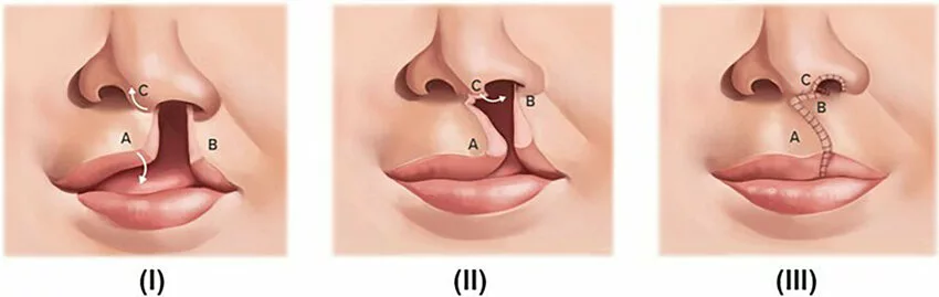 Preoperative, transoperative, and postoperative views of Millard cheiloplasty for cleft lip repair.