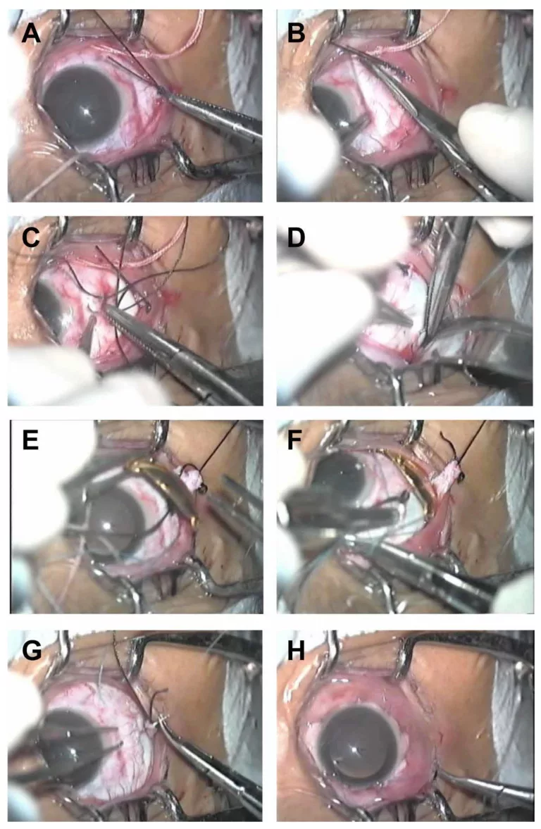 Plaque radiation therapy for uveal melanoma