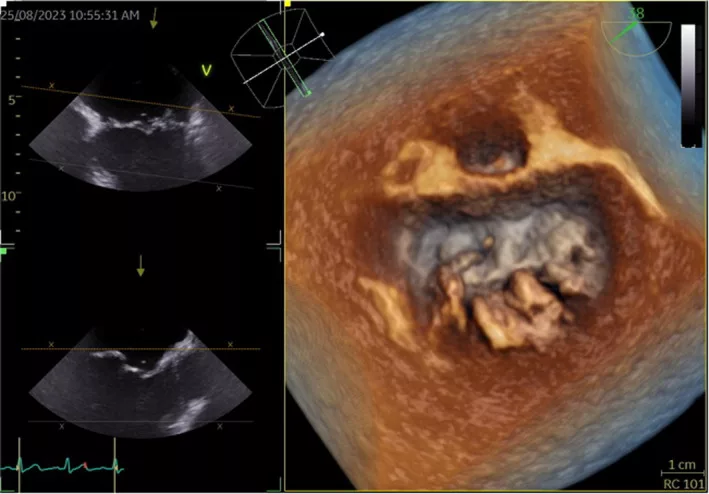 Q fever endocarditis