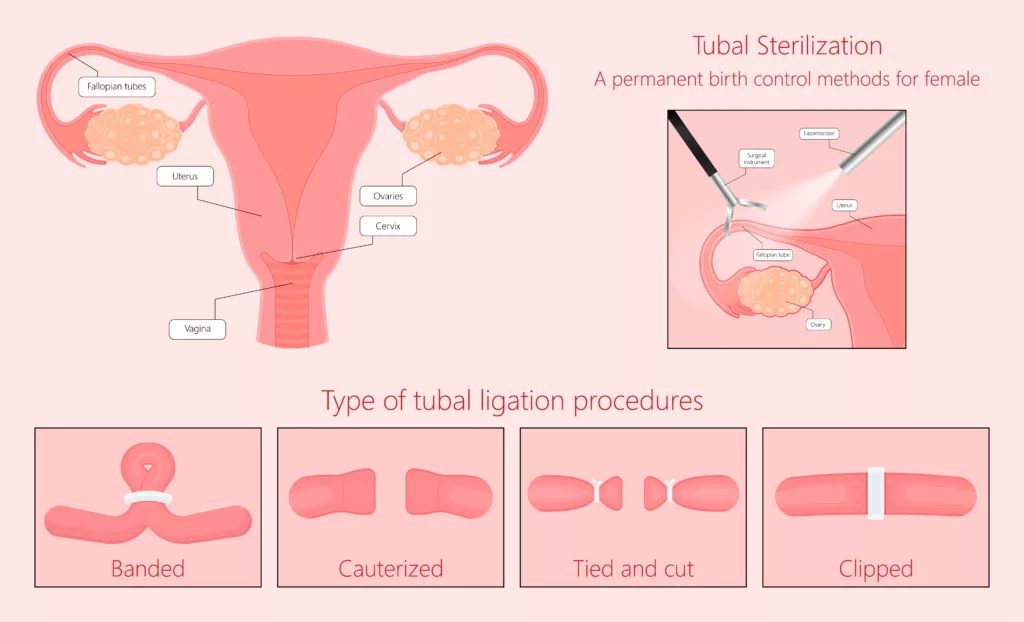 Types of Tubal Ligation