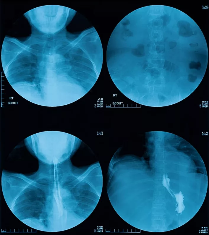 Barium swallow results