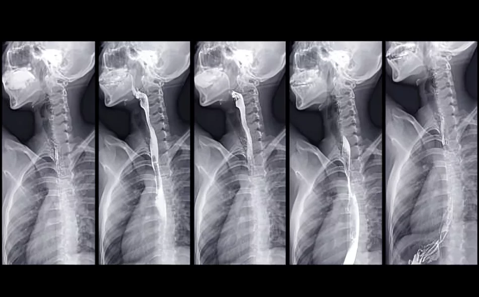 Barium swallow images