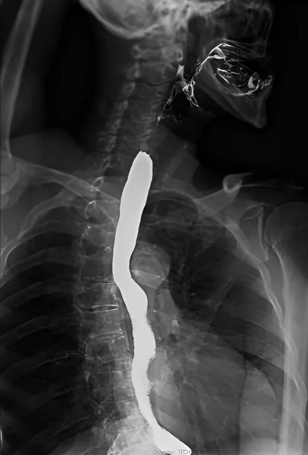 Barium swallow for Barrett esophagus